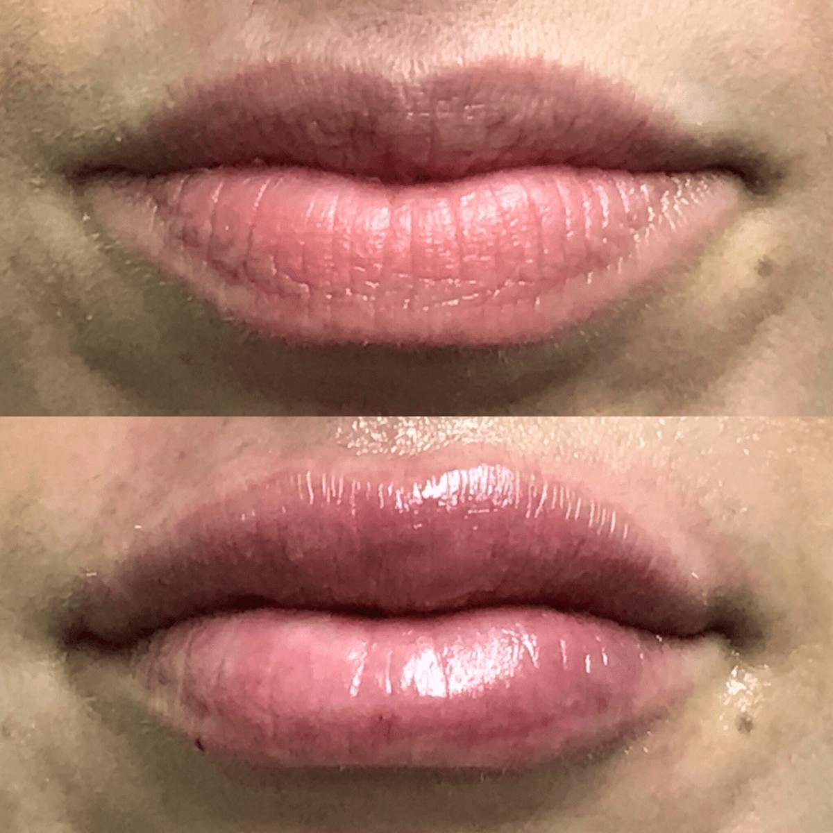 Lip Injections Before & After Gallery - Patient 187879 - Image 1