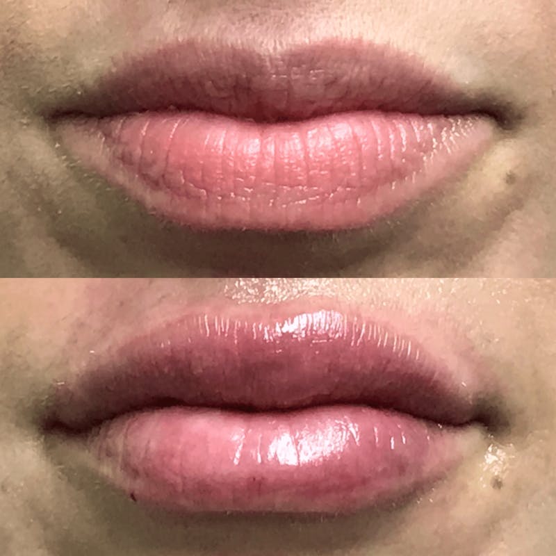Lip Injections Before & After Gallery - Patient 187879 - Image 1