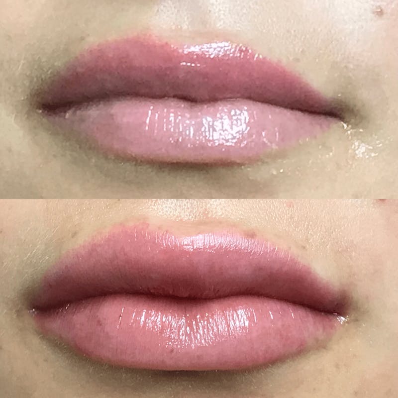 Lip Injections Before & After Gallery - Patient 427790 - Image 1