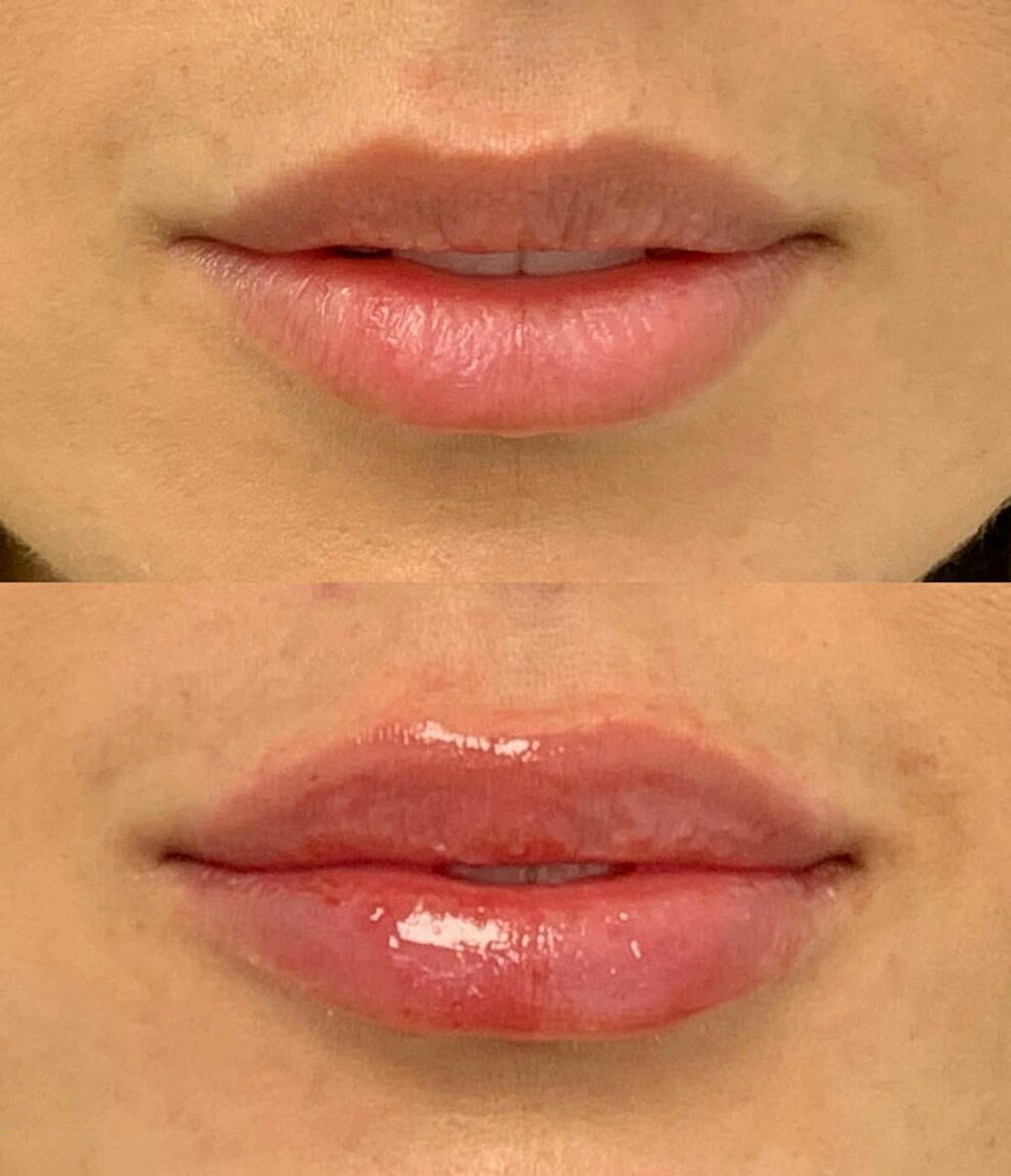 Lip Injections Before & After Gallery - Patient 299780 - Image 1