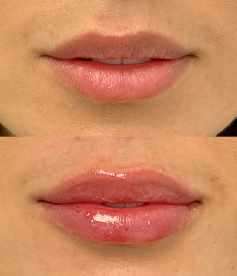 Lip Injections Before & After Gallery - Patient 299780 - Image 1