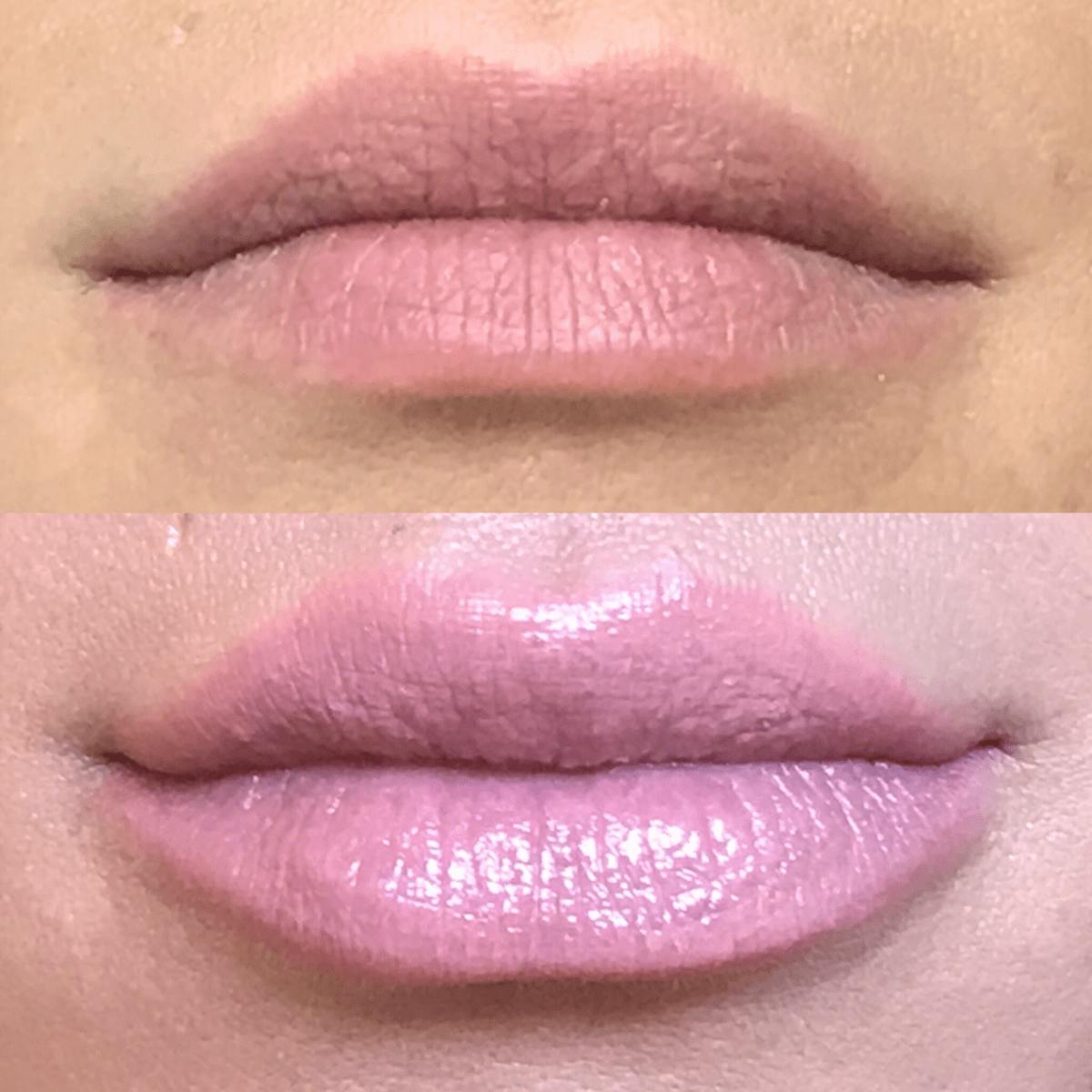 Lip Injections Before & After Gallery - Patient 971000 - Image 1