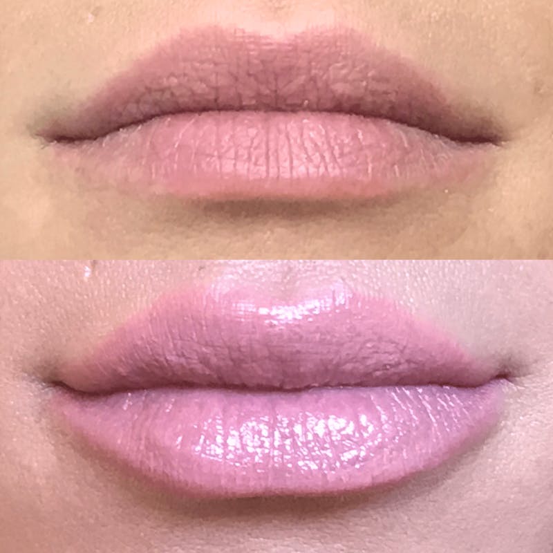 Lip Injections Before & After Gallery - Patient 971000 - Image 1