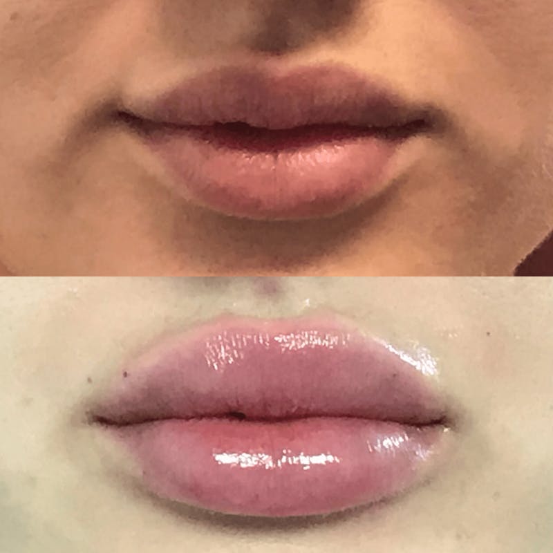 Lip Injections Before & After Gallery - Patient 322645 - Image 1