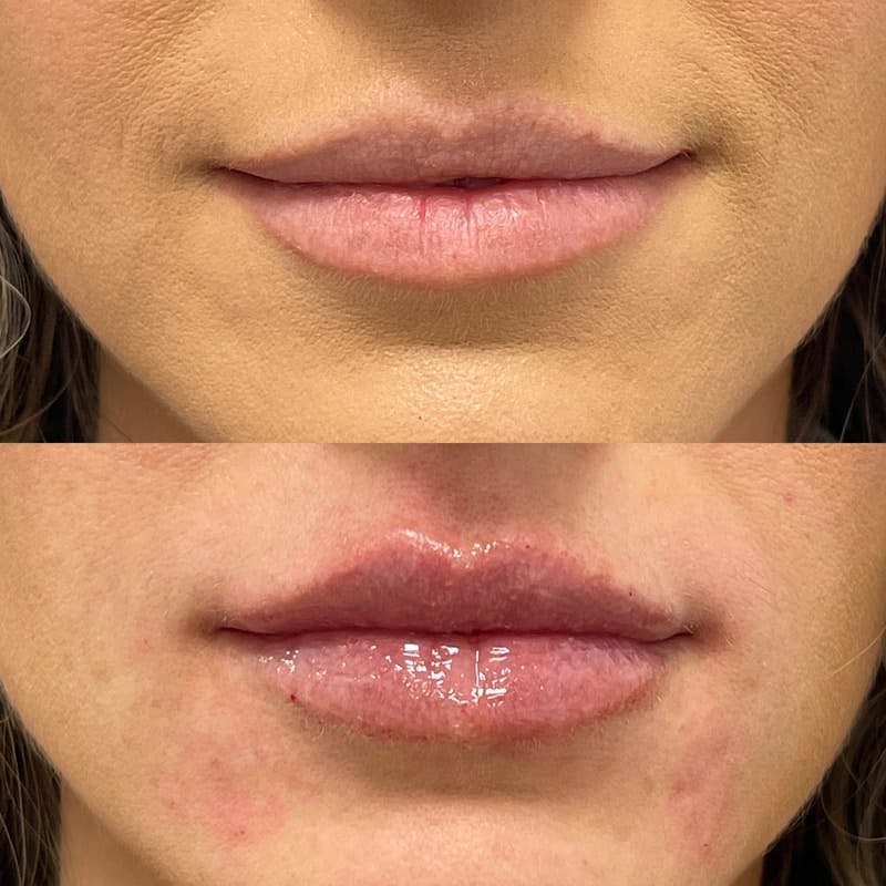 Lip Injections Before & After Gallery - Patient 220217 - Image 1