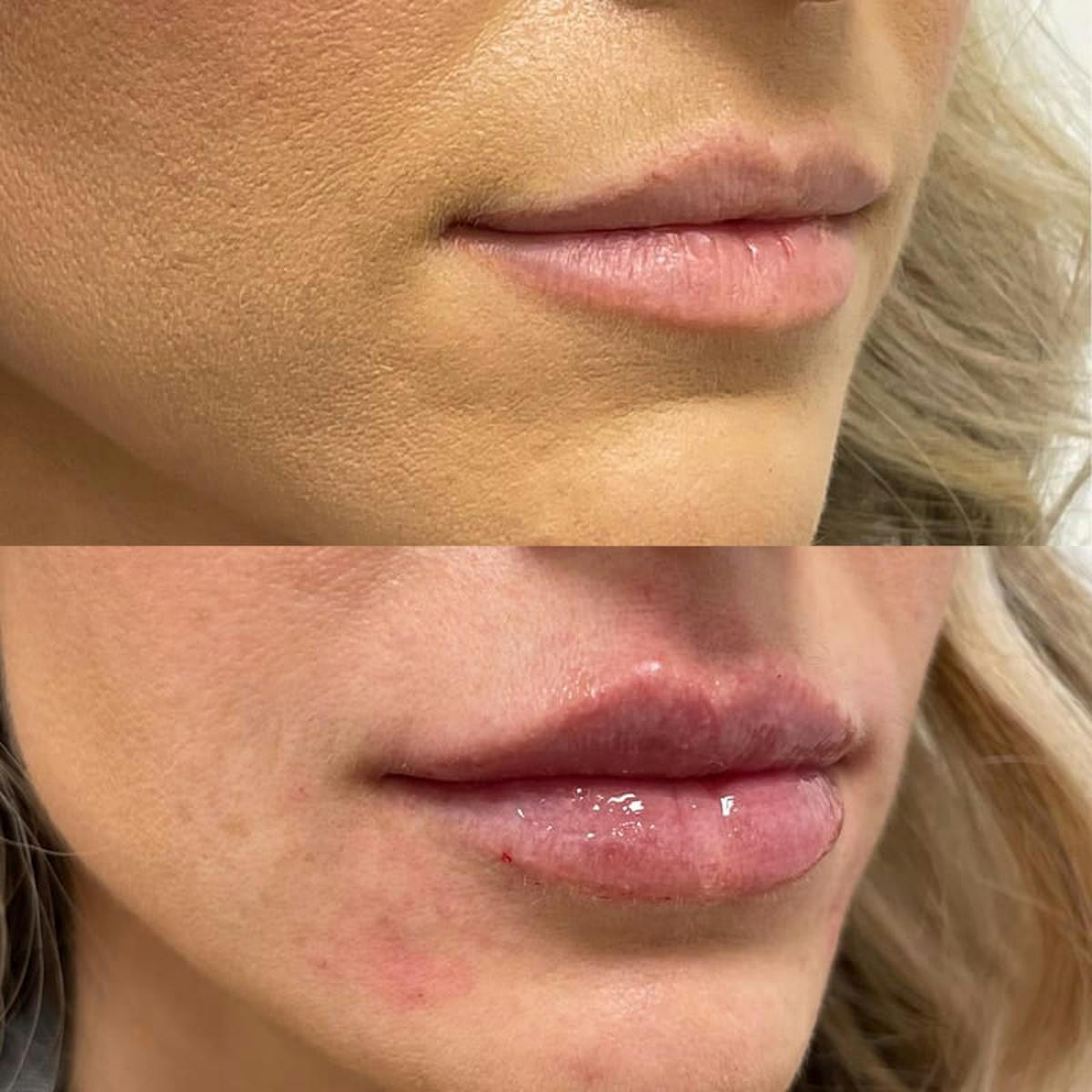 Lip Injections Before & After Gallery - Patient 220217 - Image 2