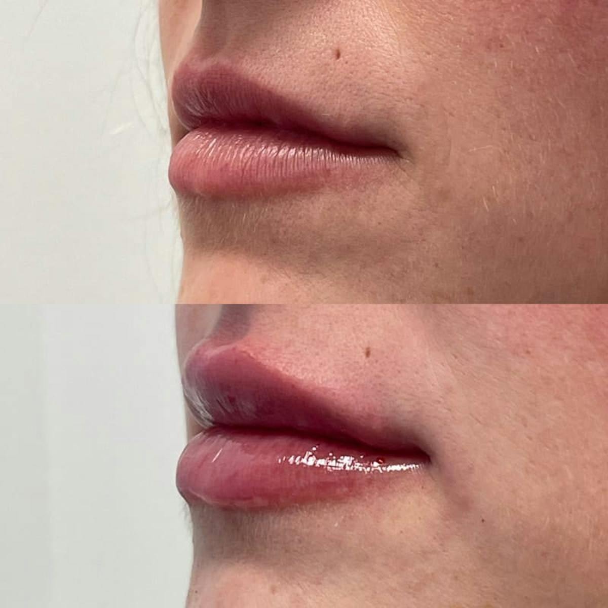 Lip Injections Before & After Gallery - Patient 301883 - Image 2