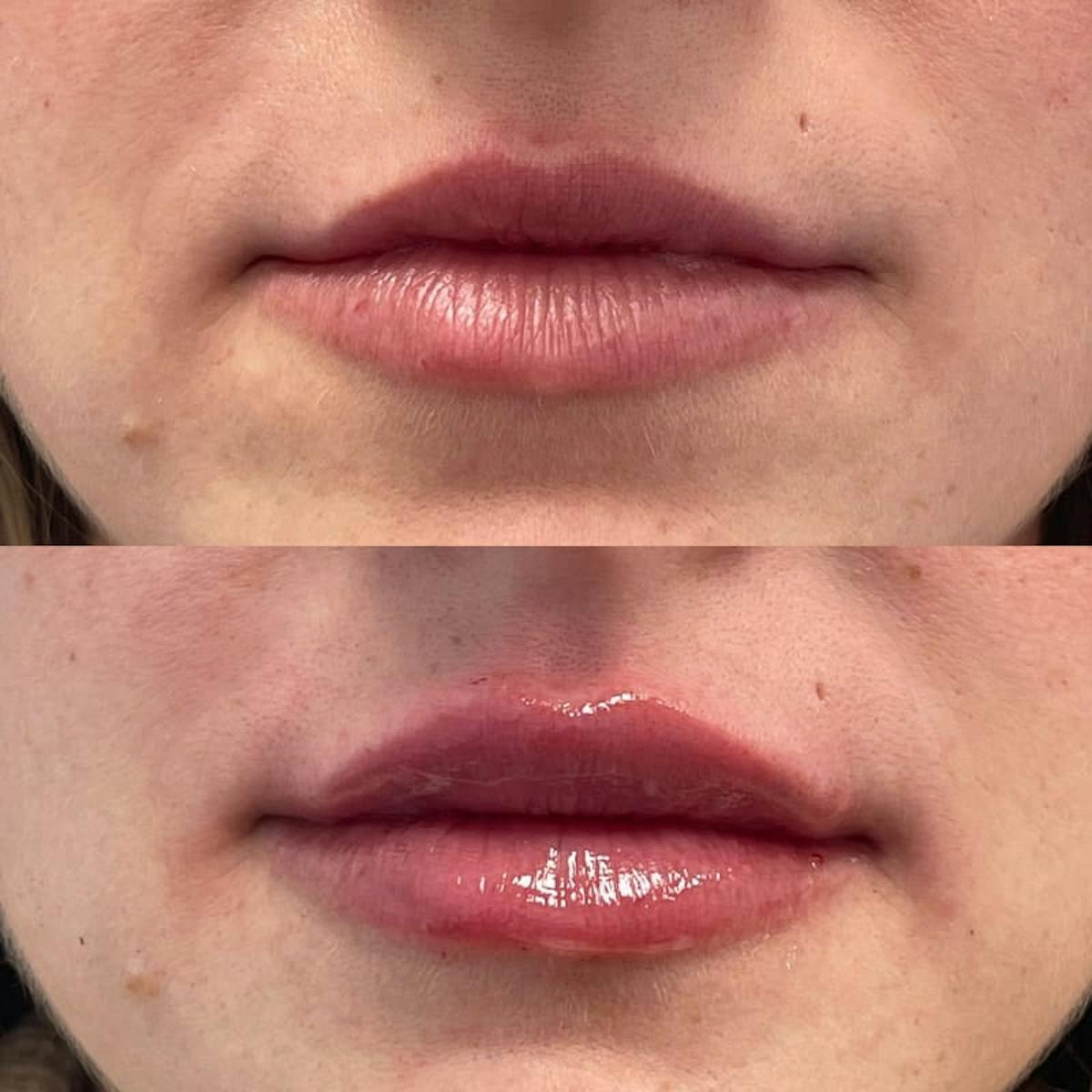 Lip Injections Before & After Gallery - Patient 301883 - Image 1