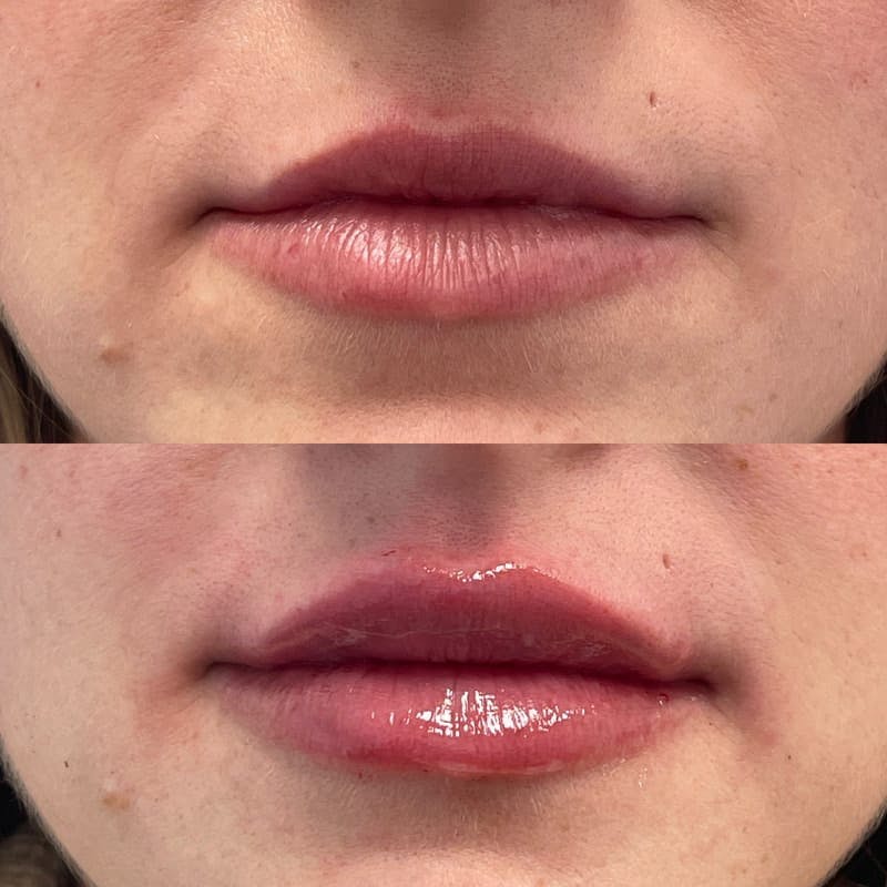 Lip Injections Before & After Gallery - Patient 301883 - Image 1