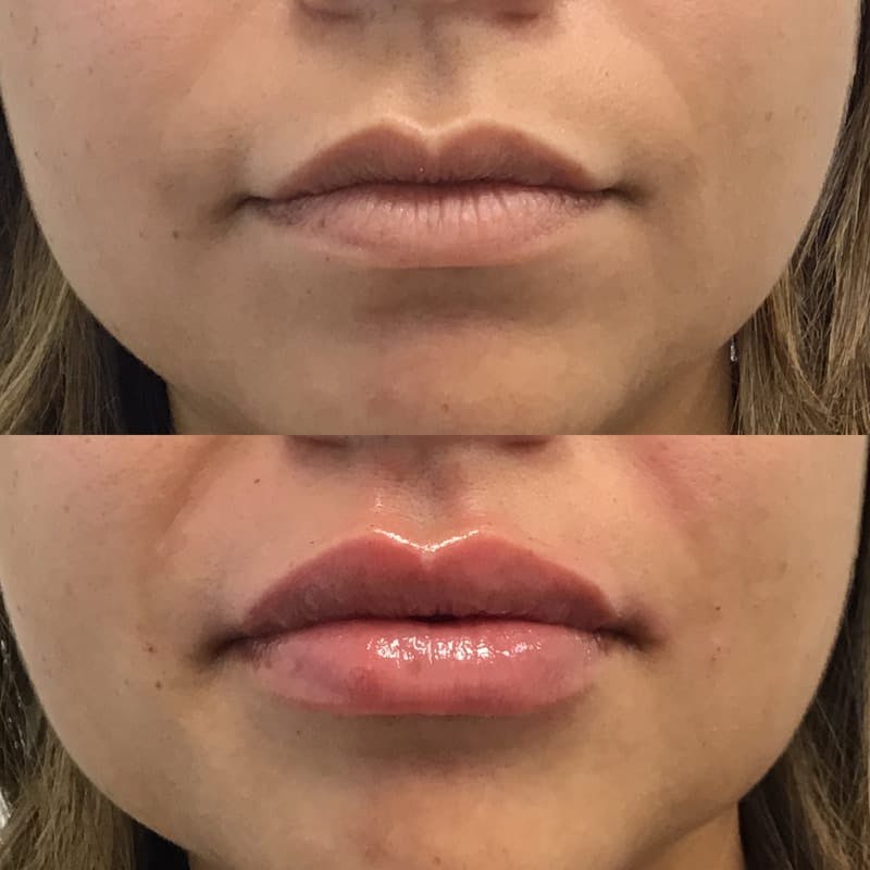 Lip Injections Before & After Gallery - Patient 204005 - Image 1