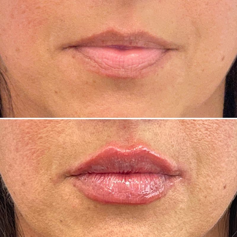 Lip Injections Before & After Gallery - Patient 162768 - Image 1