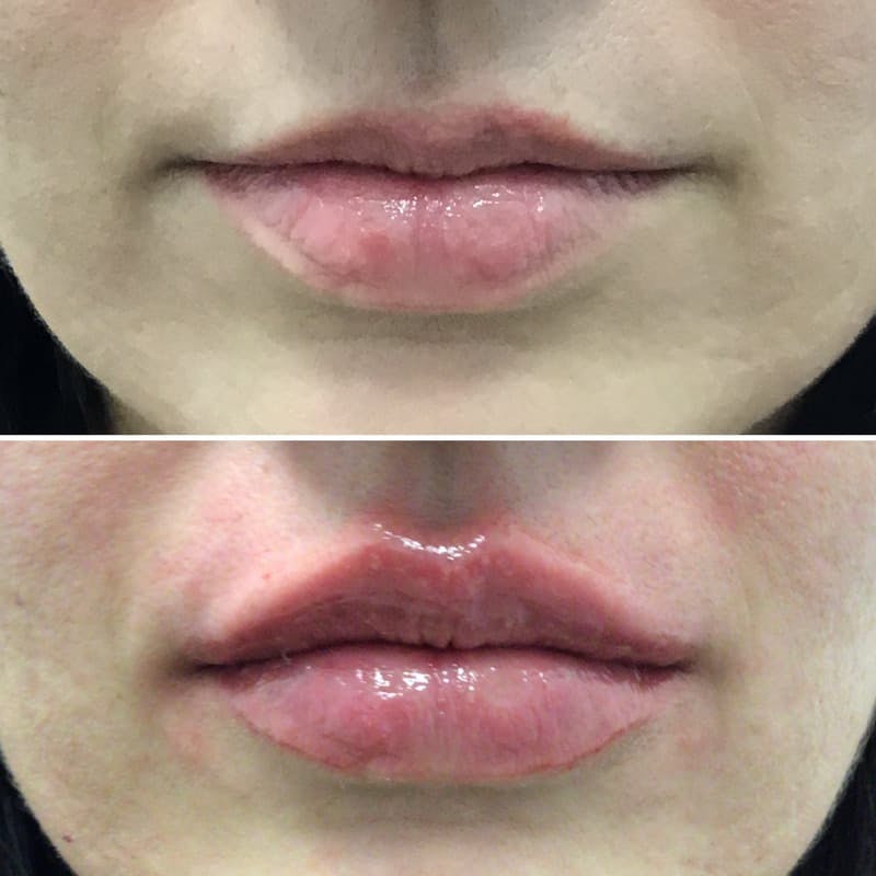 Lip Injections Before & After Gallery - Patient 271275 - Image 1