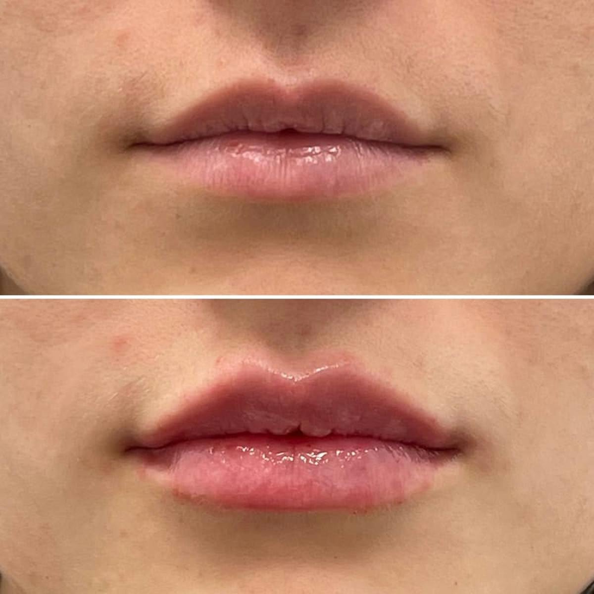 Lip Injections Before & After Gallery - Patient 193915 - Image 1