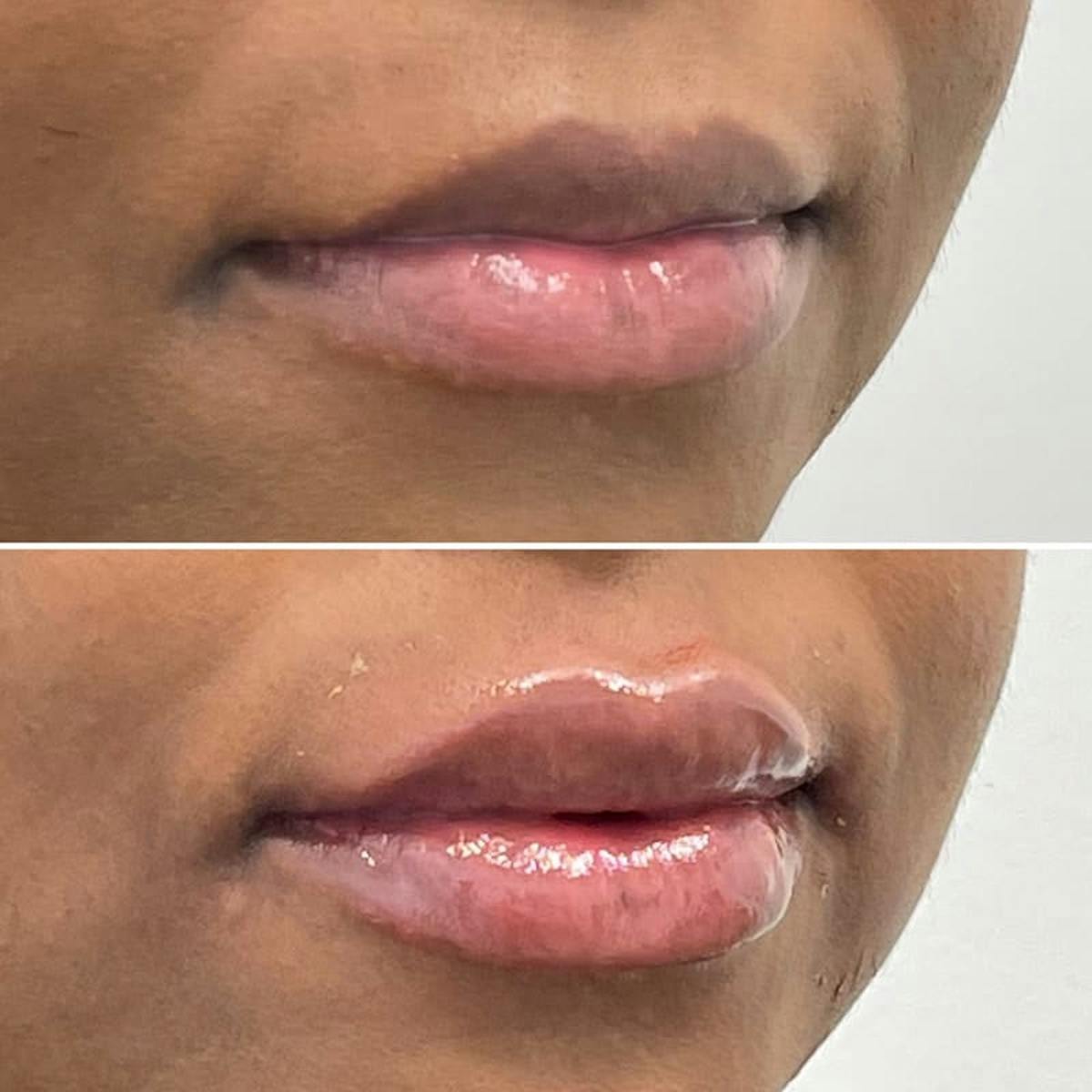 Lip Injections Before & After Gallery - Patient 385514 - Image 2