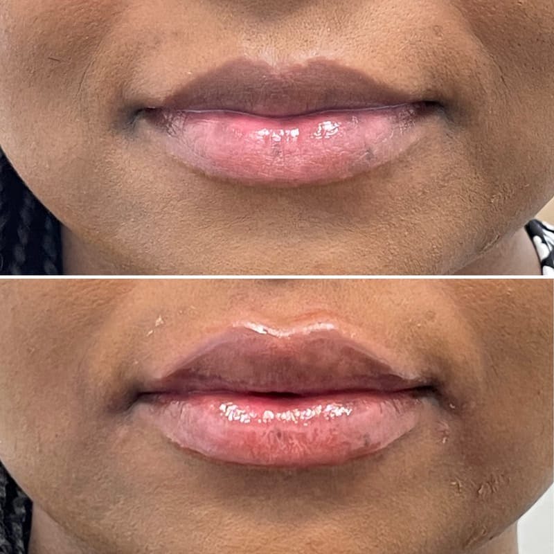 Lip Injections Before & After Gallery - Patient 385514 - Image 1