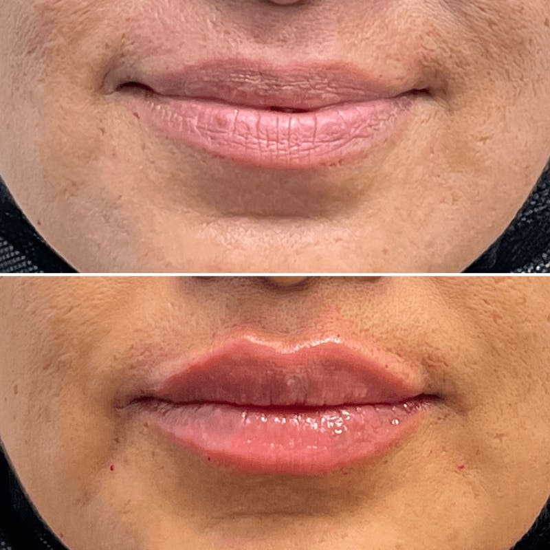 Lip Injections Before & After Gallery - Patient 671891 - Image 1