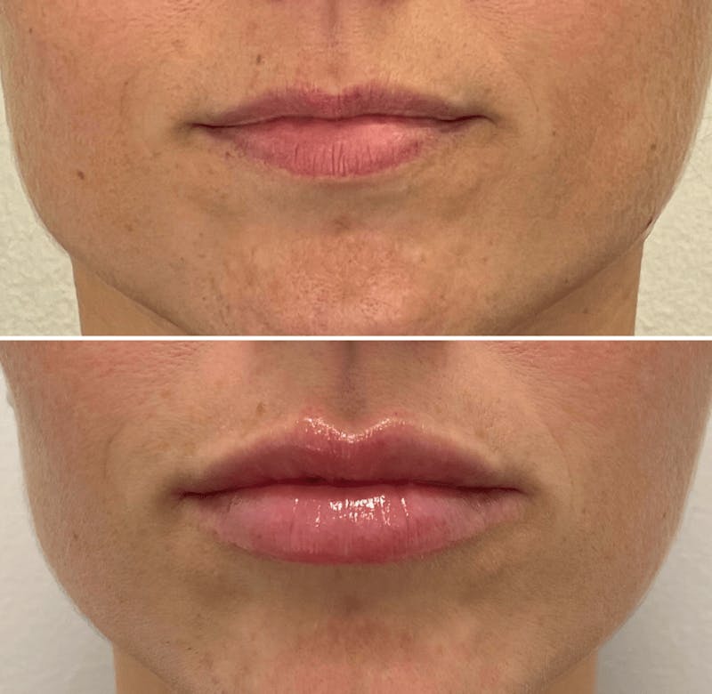 Lip Injections Before & After Gallery - Patient 245600 - Image 1