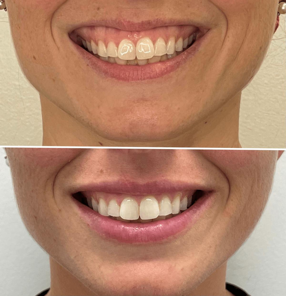 Lip Injections Before & After Gallery - Patient 206633 - Image 1