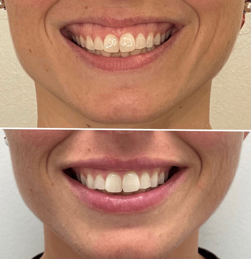 Lip Injections Before & After Gallery - Patient 206633 - Image 1