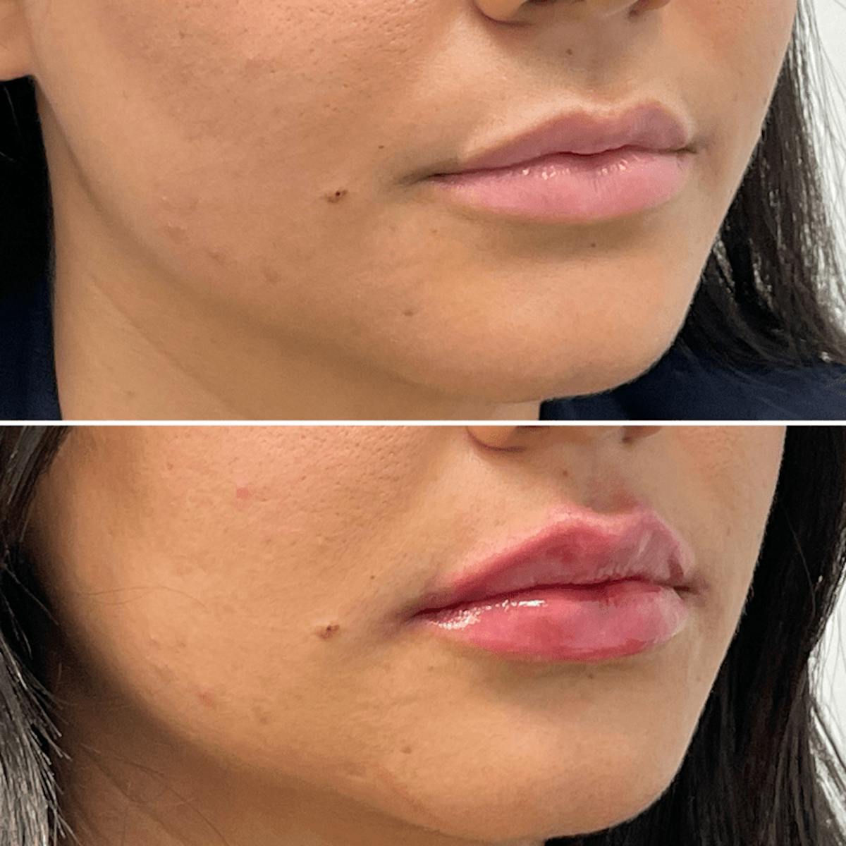Lip Injections Before & After Gallery - Patient 375542 - Image 2