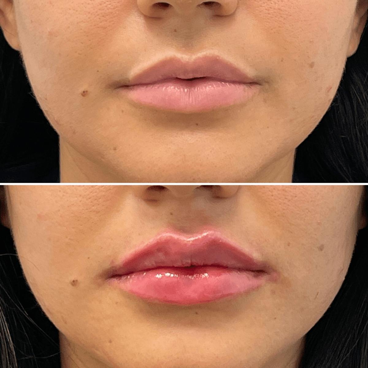 Lip Injections Before & After Gallery - Patient 375542 - Image 1