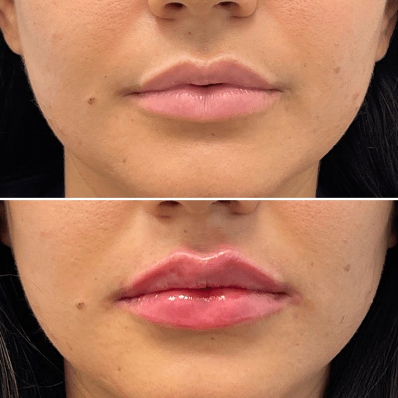 Lip Injections Before & After Gallery - Patient 375542 - Image 1