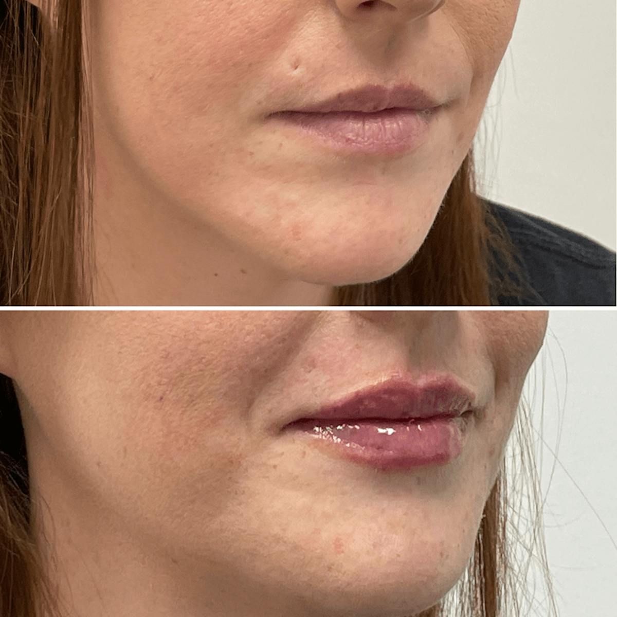 Lip Injections Before & After Gallery - Patient 353797 - Image 2