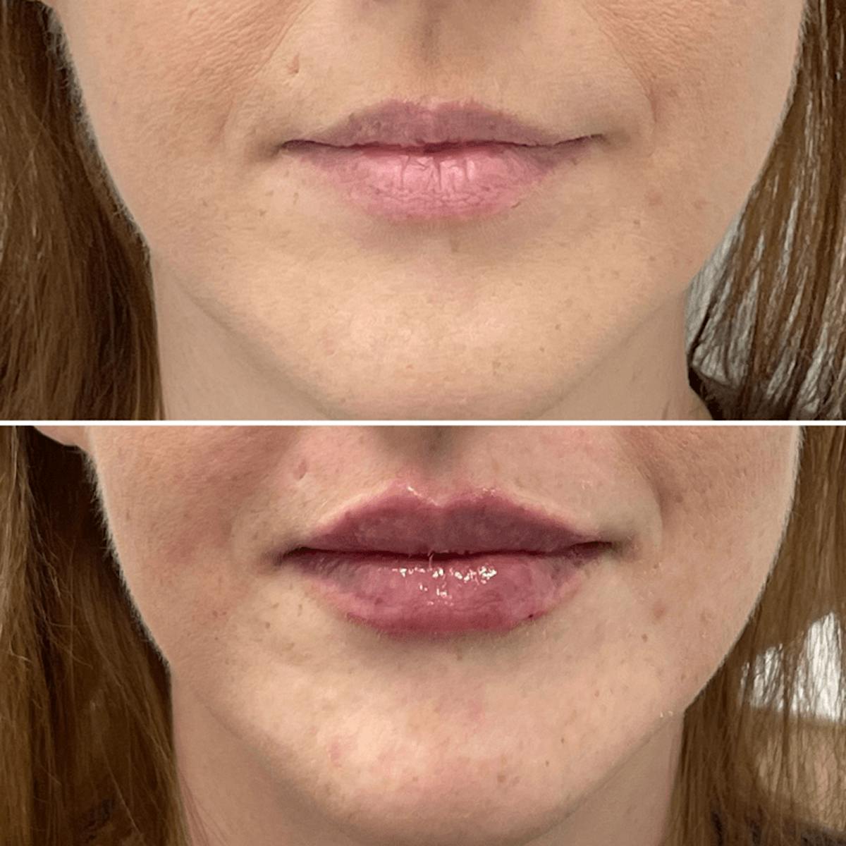 Lip Injections Before & After Gallery - Patient 353797 - Image 1