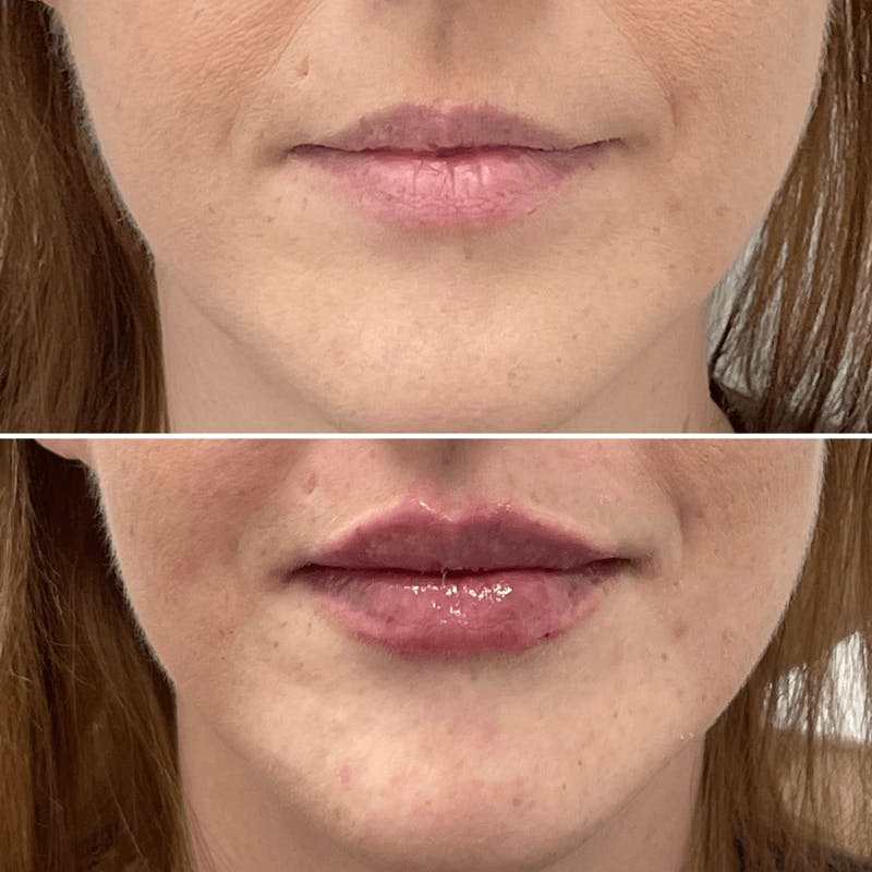 Lip Injections Before & After Gallery - Patient 353797 - Image 1