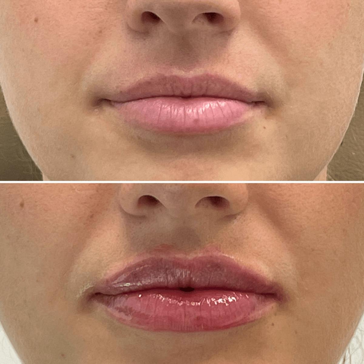 Lip Injections Before & After Gallery - Patient 633582 - Image 1
