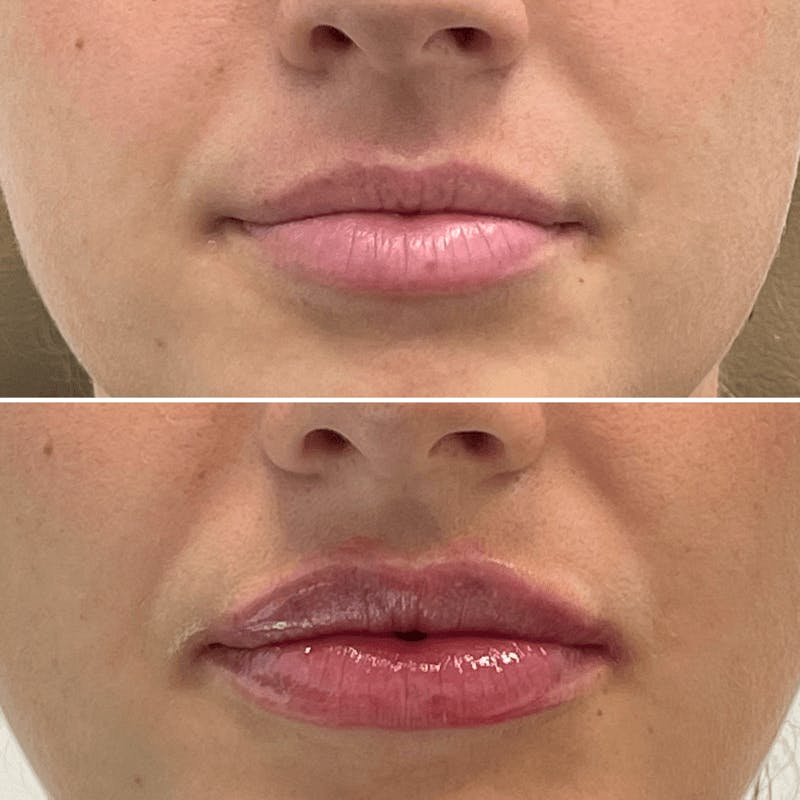 Lip Injections Before & After Gallery - Patient 633582 - Image 1