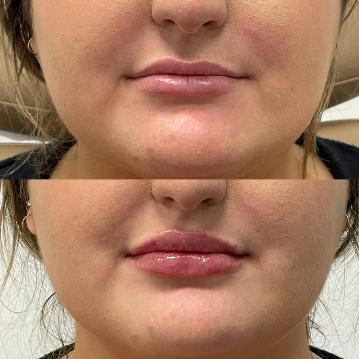 Lip Injections Before & After Gallery - Patient 391862 - Image 1