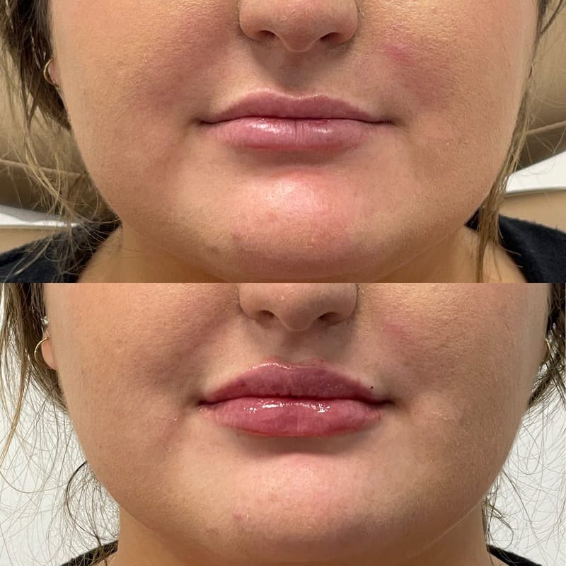 Lip Injections Before & After Gallery - Patient 391862 - Image 1