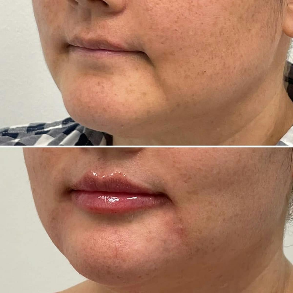 Lip Injections Before & After Gallery - Patient 329880 - Image 2