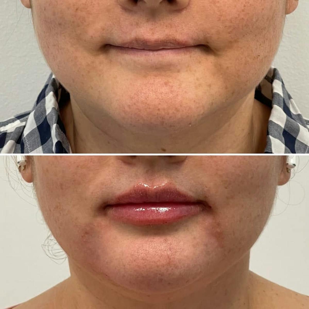 Lip Injections Before & After Gallery - Patient 329880 - Image 1