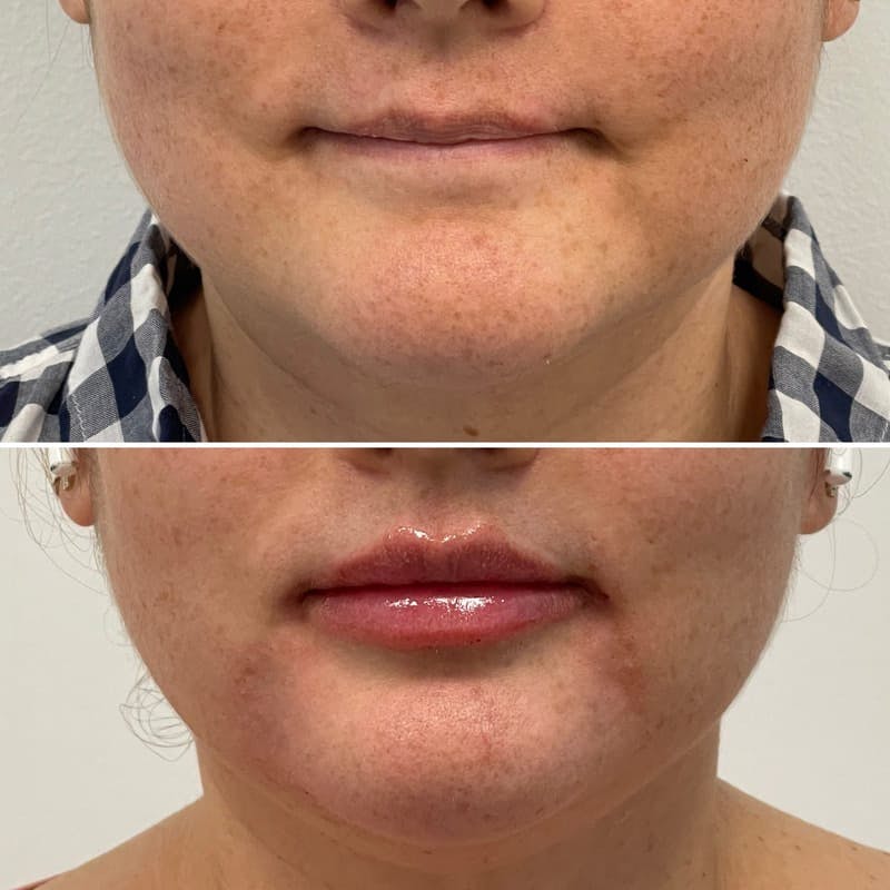 Lip Injections Before & After Gallery - Patient 329880 - Image 1