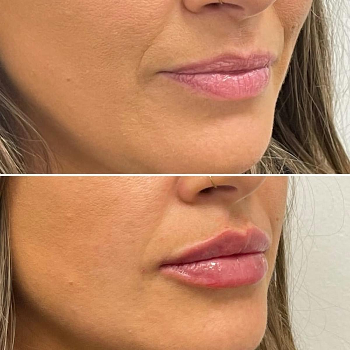 Lip Injections Before & After Gallery - Patient 394055 - Image 2