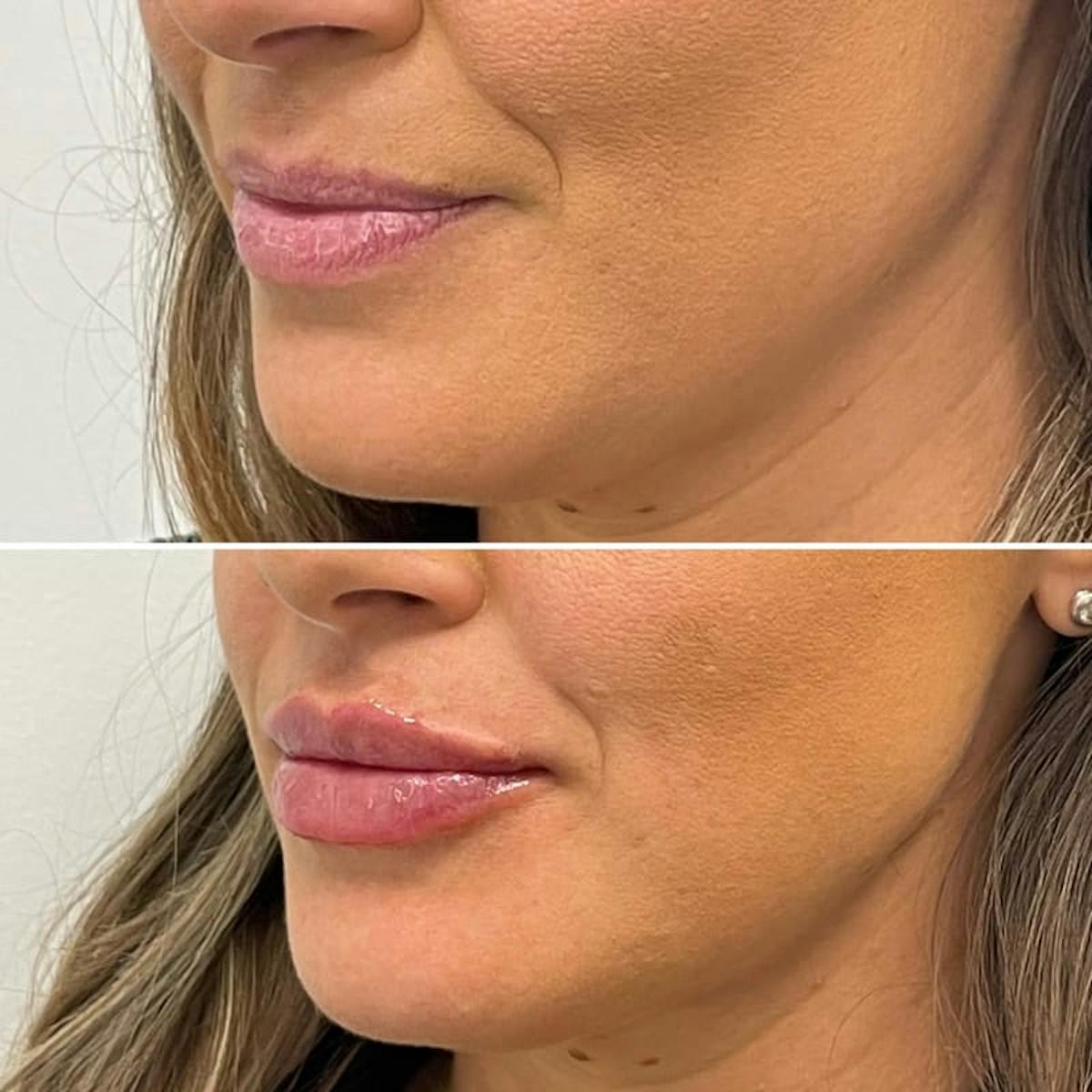 Lip Injections Before & After Gallery - Patient 394055 - Image 3