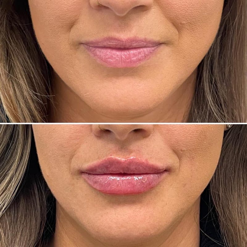 Lip Injections Before & After Gallery - Patient 394055 - Image 1