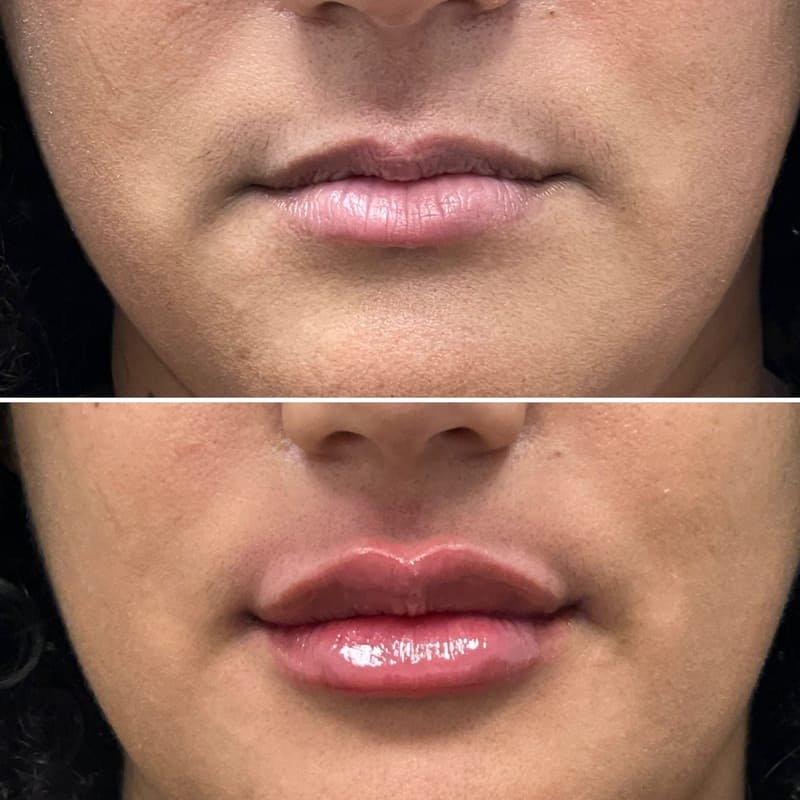 Lip Injections Before & After Gallery - Patient 432787 - Image 1