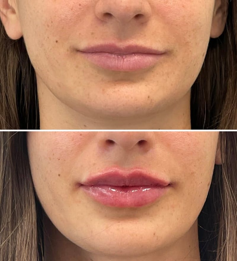 Lip Injections Before & After Gallery - Patient 396349 - Image 1