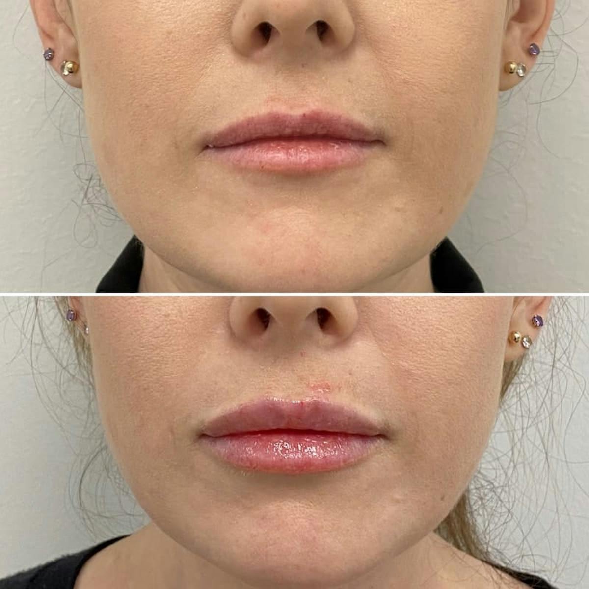 Lip Injections Before & After Gallery - Patient 209480 - Image 1