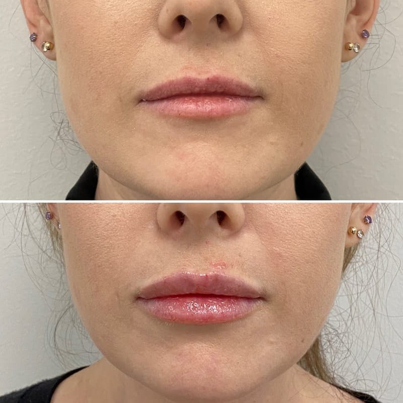 Lip Injections Before & After Gallery - Patient 209480 - Image 1
