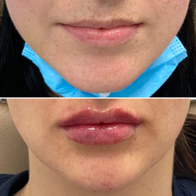 Lip Injections Before & After Gallery - Patient 848740 - Image 1