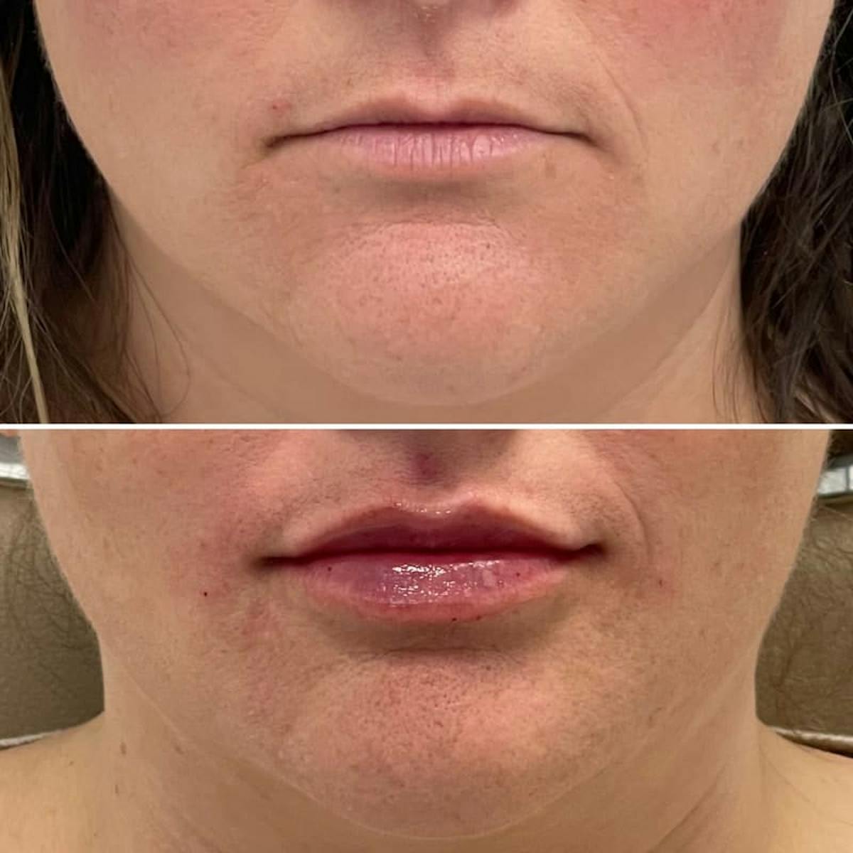 Lip Injections Before & After Gallery - Patient 345501 - Image 1