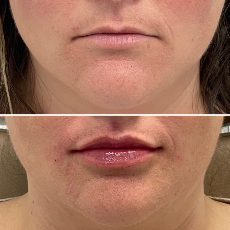 Lip Injections Before & After Gallery - Patient 345501 - Image 1