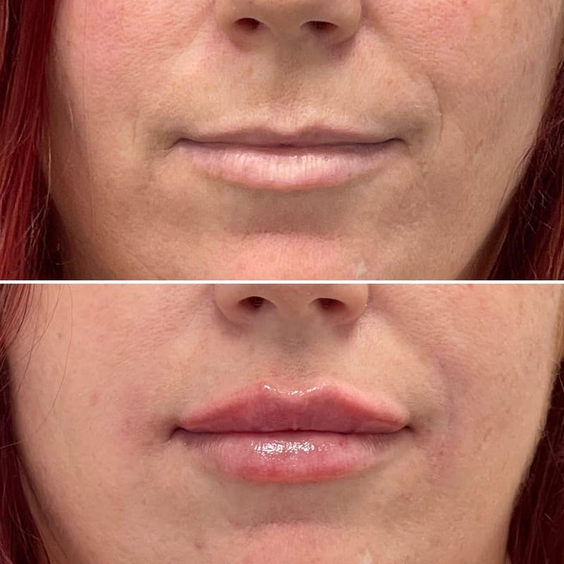 Lip Injections Before & After Gallery - Patient 372621 - Image 1