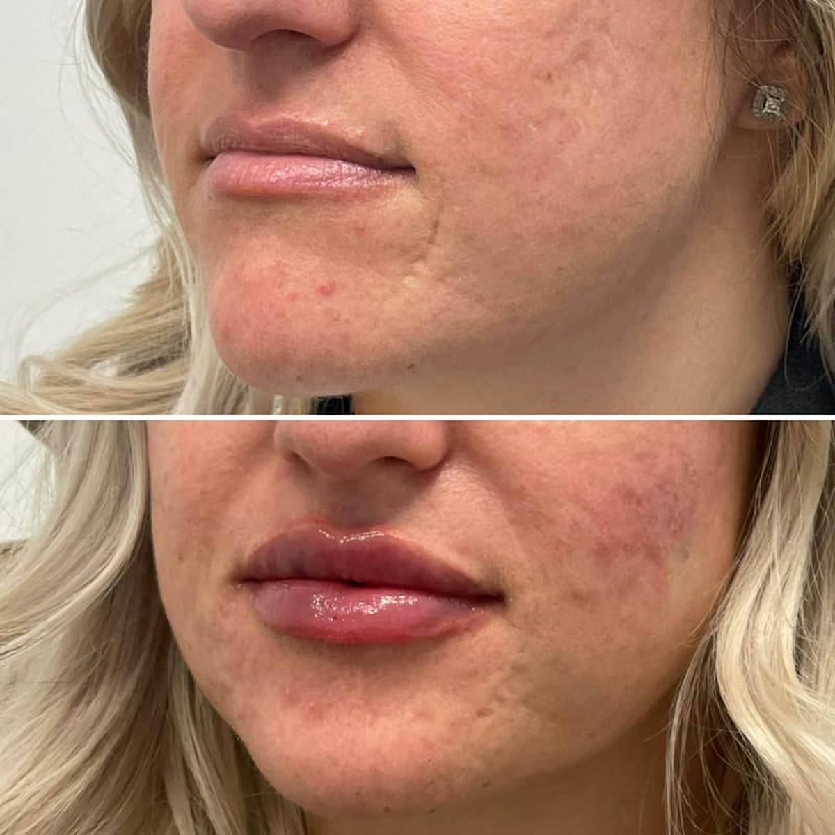 Lip Injections Before & After Gallery - Patient 174175 - Image 2