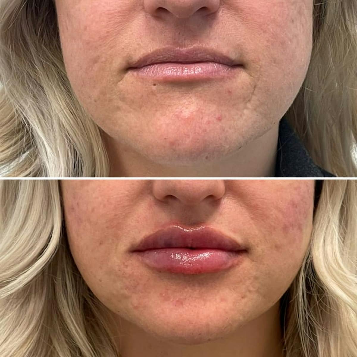 Lip Injections Before & After Gallery - Patient 174175 - Image 1