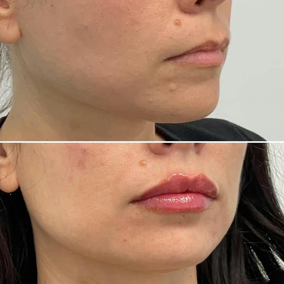 Lip Injections Before & After Gallery - Patient 320456 - Image 2